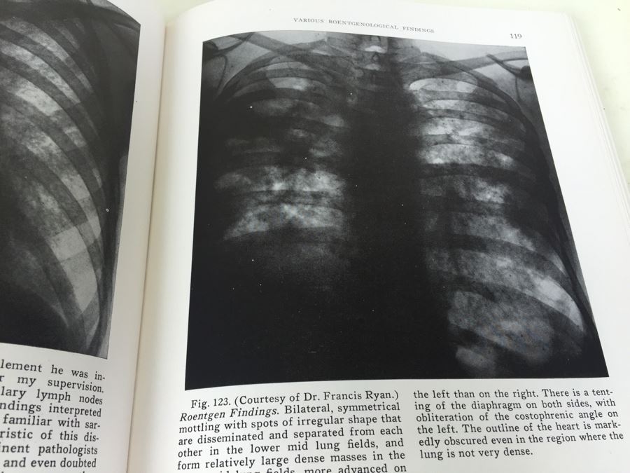 Lung Dust Lesions Versus Tuberculosis By Lewis Gregory Cole 1948 [Photo 7]