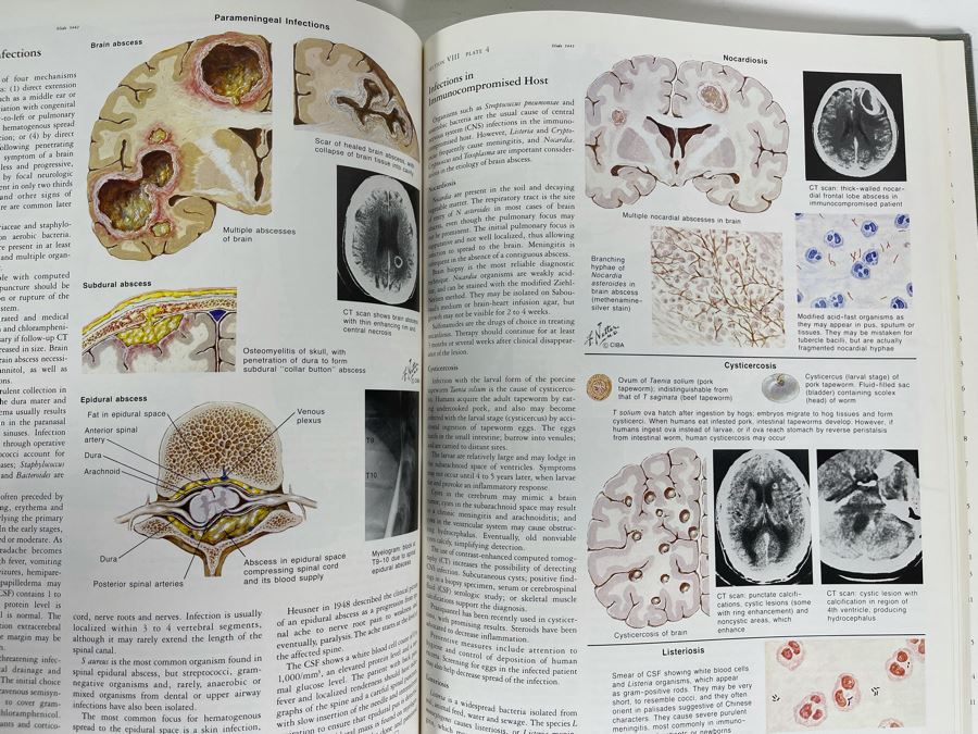 First Printing Pair Of Medical Books The CIBA Collection Of Medical Illustrations Volume I And II Nervous System: Anatomy And Physiology; Nuerologic And Neuromuscular Disorders [Photo 12]